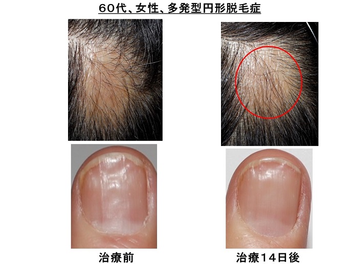 円形脱毛症　病院